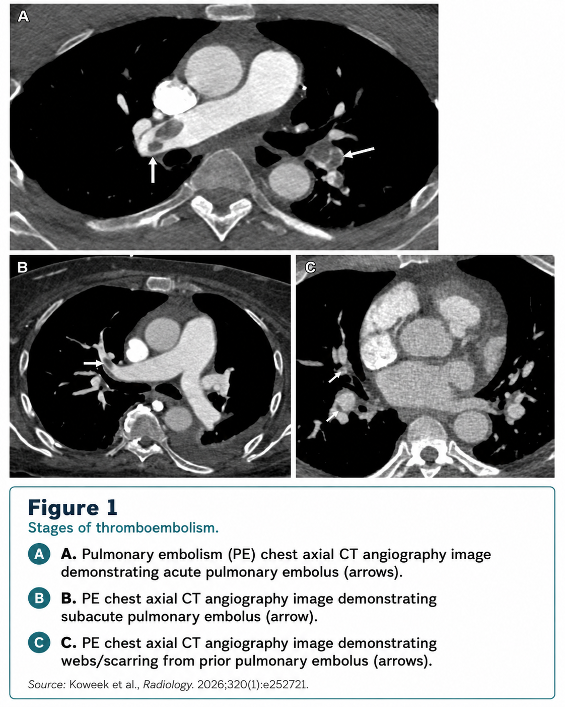 PE-RADS figure 1 stages of thromboembolism
