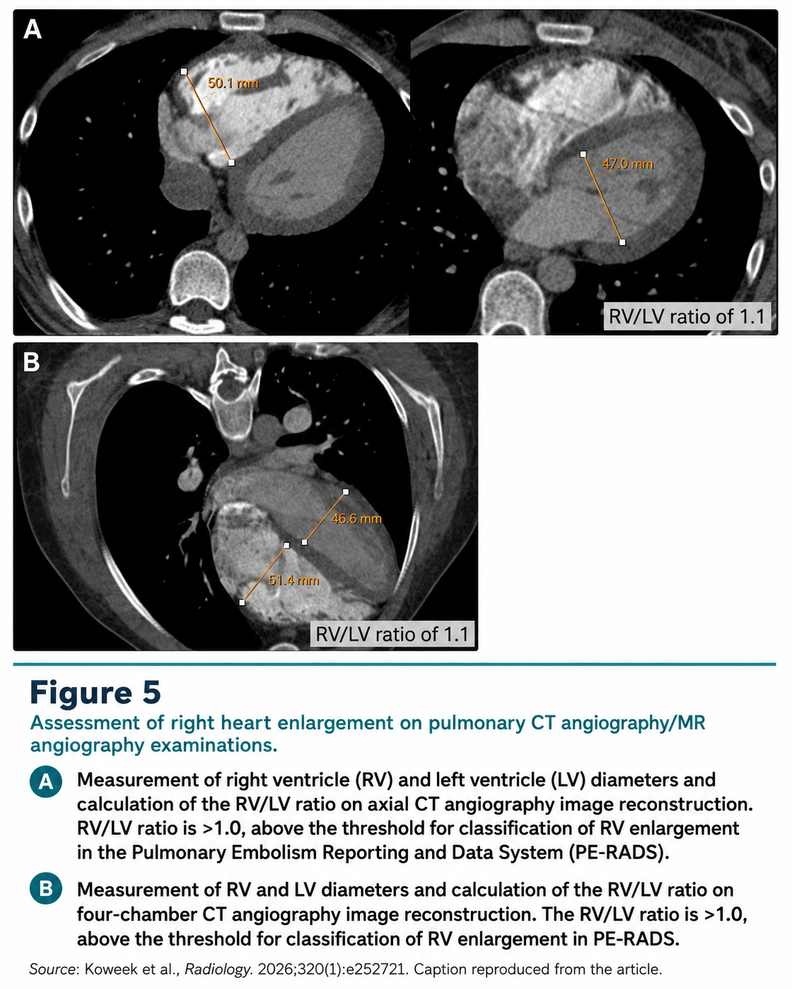 PE-RADS figure 5 right ventricular enlargement