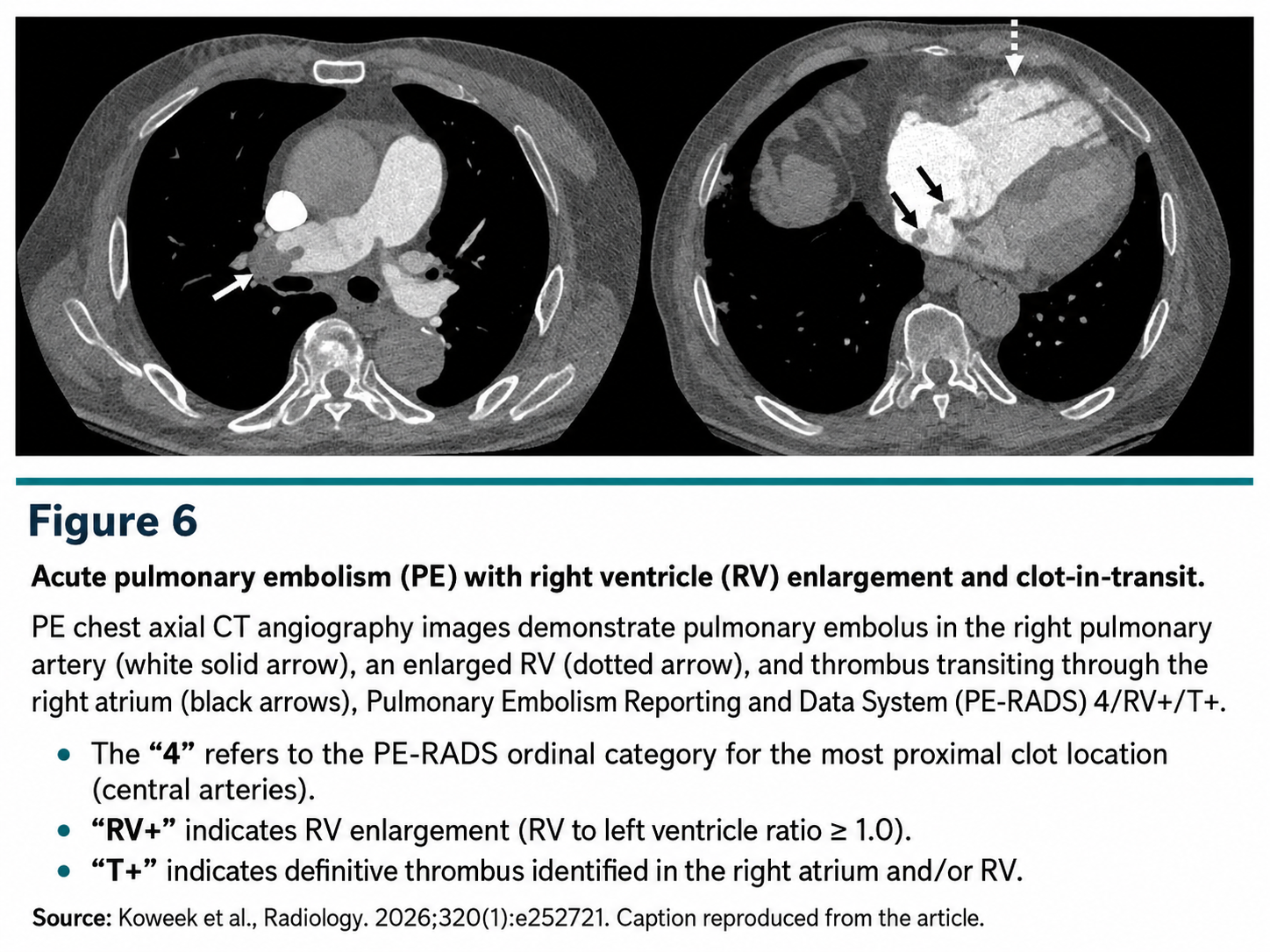 PE-RADS figure 6 RV enlargement and right heart thrombus