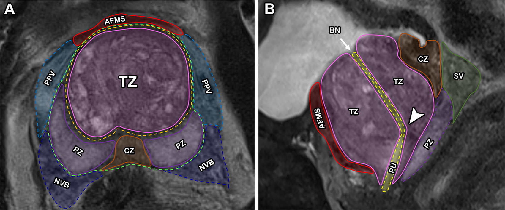 Axial (A) and sagittal (B) T2-weighted MR images show anatomic landmarks, including the bladder neck (BN) (arrow in B) and the verumontanum (arrowhead in B). The surgical capsule (light orange dashed outline in A) and prostatic capsule (green dashed outline in A) are also delineated. AFMS =anterior fibromuscular stroma (red outline), CZ = central zone (orange solid outline), NVB = neurovascular bundle (dark blue dashed outline in A), PPV = periprosthetic vessels (light blue dashed outline in A), PU = prostatic urethra (yellow dashed outline in B), PZ = peripheral zone (solid purple outline), SV = seminal vesicles (solid green outline in B), TZ = transition zone (solid pink outline).