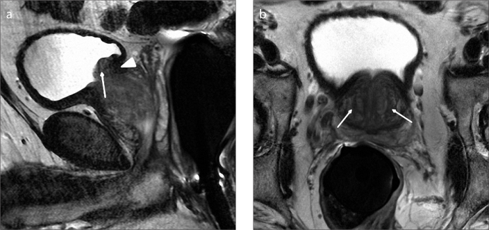 Figure 8. a, b.  Sagittal T2-weighted image (a) of a 54-year-old male with type 5 BPH shows pedunculated enlargement (arrow) and superior displacement of trigon due to retrourethral enlargement (arrowhead). Axial T2-weighted image (b) shows bilateral transition zone enlargement with BPH nodules (arrows).