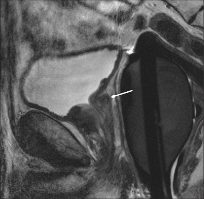 Figure 9. Sagittal T2-weighted image of a 54-year-old male with type 6 BPH shows subtrigonal enlargement (arrow) without marked displacement of trigon.