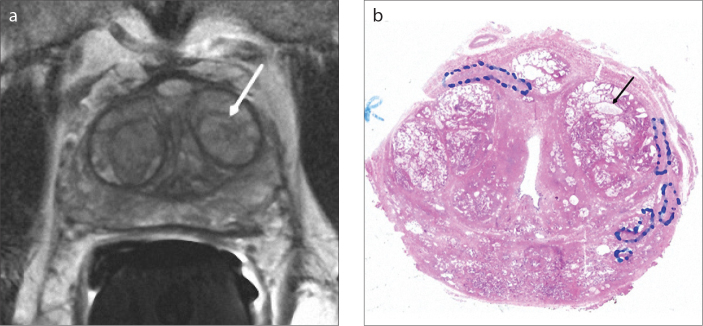 Figure 1. a, b.  Axial T2-weighted image (a) of a 70-year-old male with type 3 BPH shows a predominantly hyperintense nodule (arrow) in the left transition zone. The pathology section (b) of this nodule is compatible with a mixed type BPH nodule consisting of mostly glandular components with markedly cystic glands (arrow).