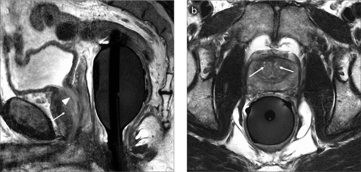 Figure 4. a, b. Sagittal T2-weighted image (a) of a 56-year-old male with type 1 BPH shows enlargement of transition zone (arrow). Note that there is posterior displacement of urethra (arrowhead) due to BPH nodules. Axial T2-weighted image (b) shows enlargement of transition zone with bilateral BPH nodules (arrows).