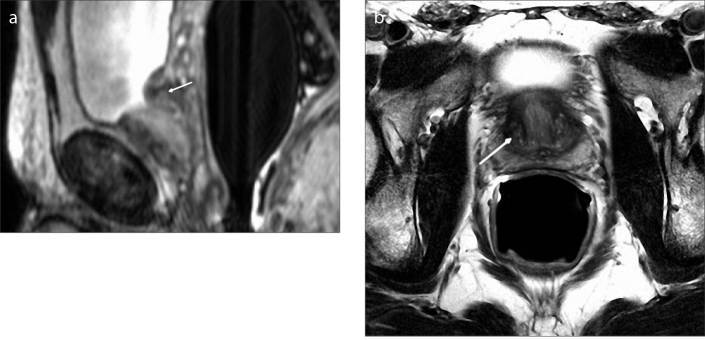 Figure 5. a, b. Sagittal T2-weighted image (a) of a 51-year-old male with type 2 BPH shows retrourethral enlargement (arrow). Axial T2-weighted image (b) shows no marked enlargement of transition zone (arrow).