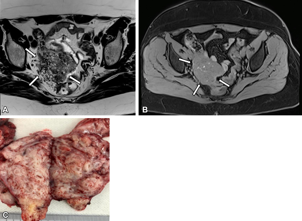 Figure 10. Presumed adnexal lesion in a 42-year-old woman with a postsurgical diagnosis of an extrauterine adenomyoma.
- (A) Axial T2-weighted MR image shows a lobulated mass (arrows) in the right pelvic paramedian region, containing cystic areas with high signal intensity interspersed with a hypointense fibrous stroma.
- (B) Axial T1-weighted MR image with fat suppression shows small hemorrhagic cystic foci in the lesion (arrows).
- (C) Photograph of the surgical specimen shows whorled, white, firm areas.