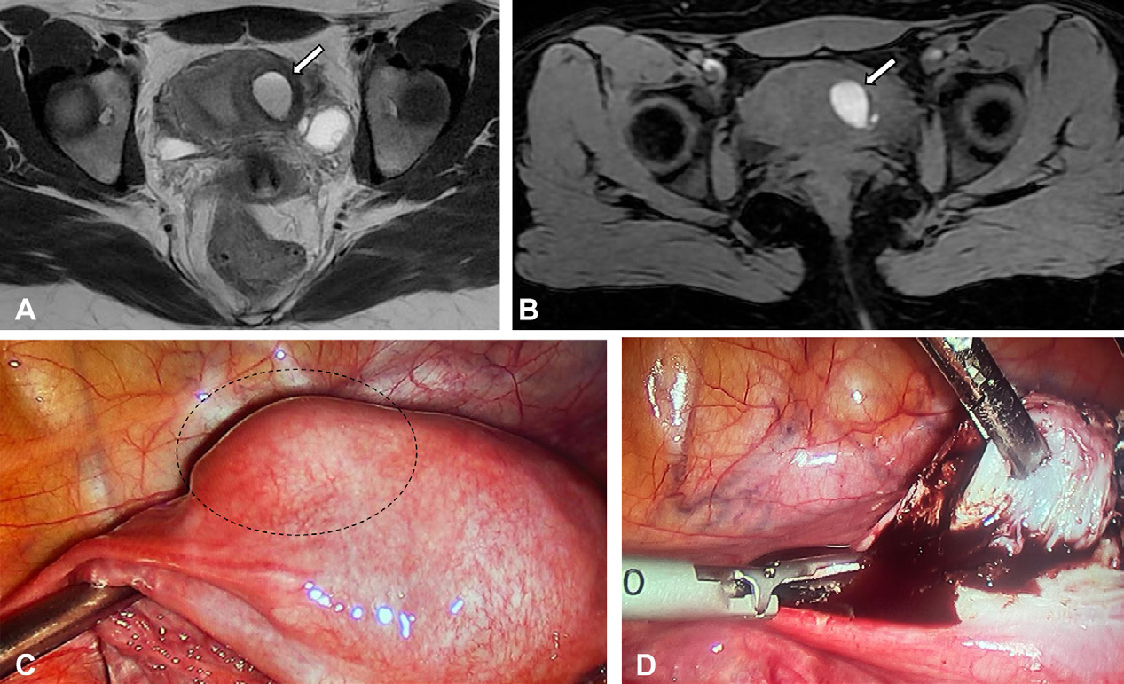 Figure 9. ACUM in a 14-year-old nulliparous adolescent girl with intense dysmenorrhea since menarche.
- (A) Axial T2-weighted MR image shows a cystic cavity lined with endometrium and surrounded by a hypointense halo in the left uterine body (arrow).
- (B) Axial T1-weighted MR image with fat saturation shows prominent high signal intensity in the central cavity, corresponding to hemorrhagic content (arrow).
- (C) Laparoscopic surgical view shows the mass on the left side of the uterus, bulging the organ (dashed circle).
- (D) Laparoscopic surgical view shows a section of the mass with chocolate-colored fluid spilling out.