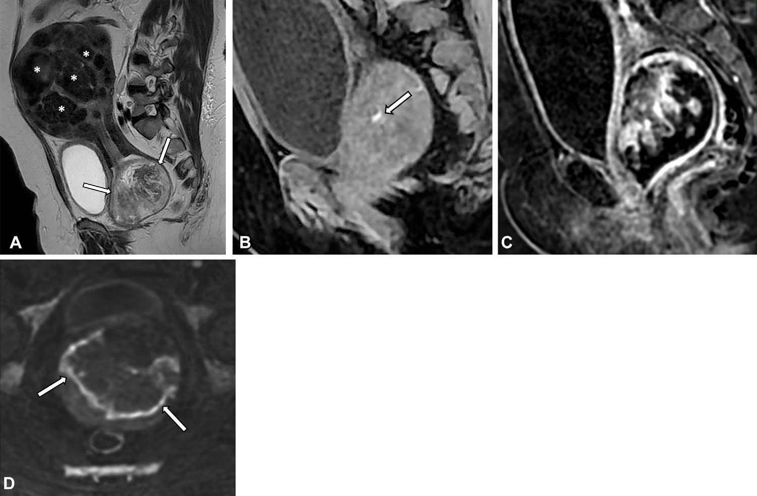 Figure 11. Atypical polypoid adenoma in a 50-year-old woman.
- (A) Sagittal T2-weighted MR image shows an enlarged uterus with multiple hypointense masses representing leiomyomas (*) and a polypoid lesion anchored in the lower uterine segment, protruding into the vagina (arrows).
- (B) Sagittal T1-weighted MR image with fat suppression shows a small hemorrhagic focus in the lesion (arrow).
- (C) Sagittal postcontrast MR image shows irregular areas of enhancement.
- (D) Diffusion- weighted MR image shows peripheral restriction (arrows).