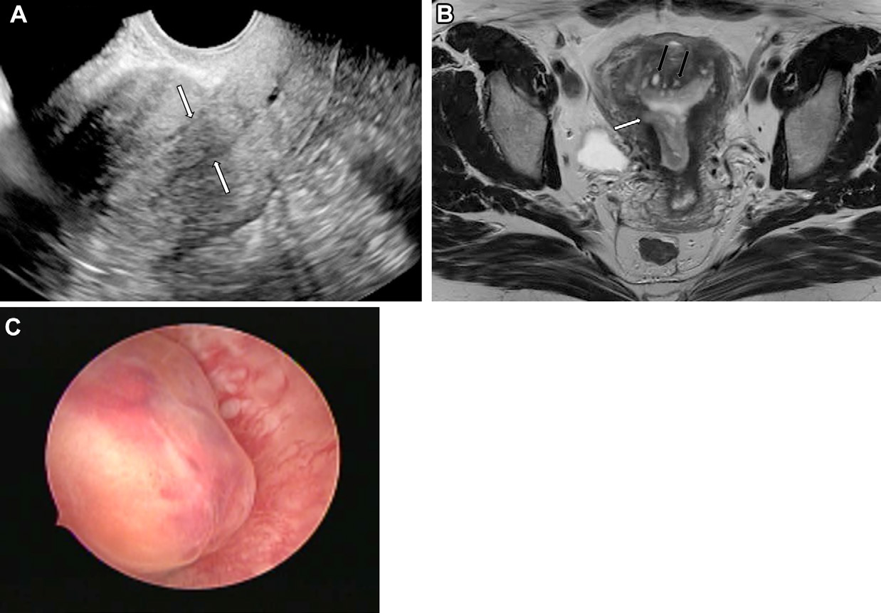 Figure 13. Polypoid adenomyoma in a 35-year-old woman.
- (A) Longitudinal endovaginal US image shows a polypoid lesion in the endometrial cavity (arrows).
- (B) Axial T2-weighted MR image shows that the lesion is anchored in the right uterine body wall with mild myometrial infiltration (white arrow) and contains a predominantly cystic component in its central portion. Uterine adenomyosis is also observed (black arrows).
- (C) Hysteroscopic view shows the lobulated surface of the polyp.