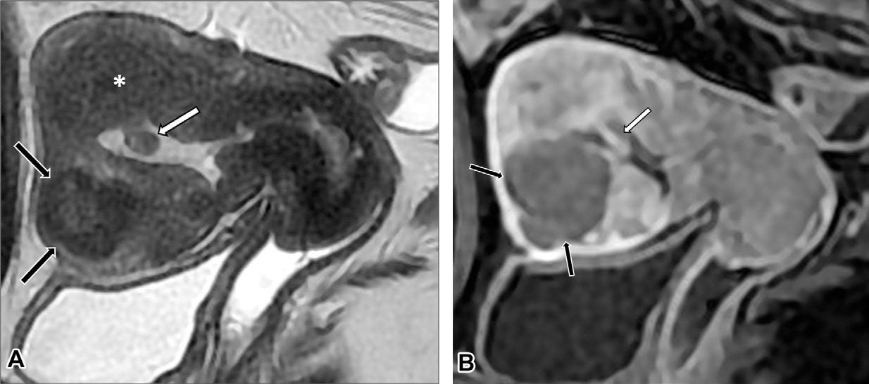 in a 33-year-old woman shows a hypointense intramyometrial mass in the left uterine wall with partially defined margins, minimal mass effect, and small internal hyperintense foci, which are findings characteristic of an adenomyoma (arrows).
- (B) Axial T2-weighted MR image during the third trimester of pregnancy when the patient was 36 years old shows a heterogeneously thickened left myometrium with scattered cystic areas (arrows). A normal placenta (black *) and an additional finding of a leiomyoma (white *) are also visible.