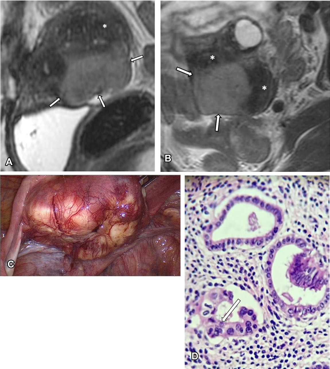 Figure 17. Endometrioid adenocarcinoma in a 52-year-old woman who was undergoing imaging follow-up for uterine adenomyosis. (A, B) Sagittal
- (A) and axial
- (B) T2-weighted MR images reveal a diffusely enlarged uterus with adenomyosis (*) and a lobulated mass of intermediate to high signal intensity located in the posterior uterine wall (arrows).
- (C) Laparoscopic view shows the mass.
- (D) Photomicrograph shows marked nuclear pleomorphism (arrow).