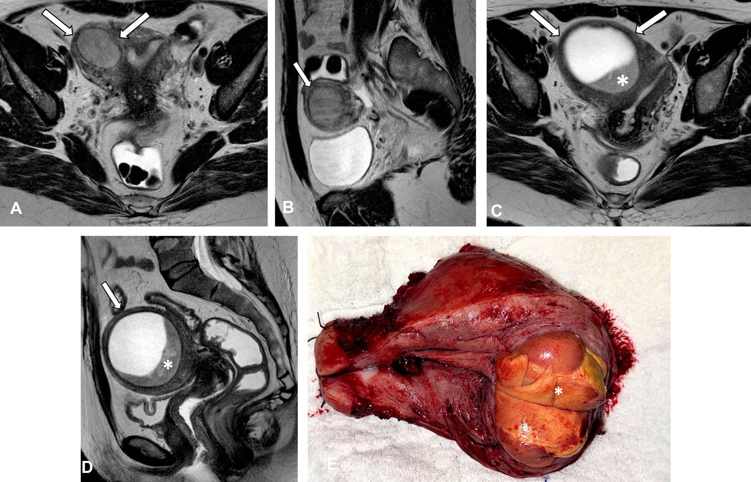 Figure 18. Adenomyosis in a 46-year-old woman with confirmed low-grade endometrial stromal sarcoma. (A, B) Axial
- (A) and sagittal
- (B) T2-weighted MR images show a large myometrial cystic mass abutting the uterine cavity (arrows). (C, D) Axial
- (C) and sagittal
- (D) T2-weighted MR images acquired 3 years later show substantial growth of the lesion (arrows), which exhibits prominent high signal intensity and a peripheral hypointense component (*) corresponding to solid areas or clots . The patient did not receive intravenous contrast material due to a history of allergy.
- (E) Photograph of the surgical specimen shows the mass (*).