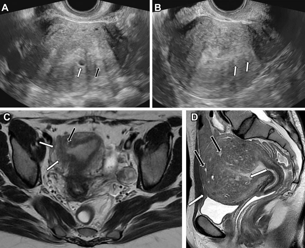 Figure 1. Endovaginal US and MRI features of typical adenomyosis in different patients who are in the menacme.
- (A) Transverse US image shows a myometrial cyst (white arrow) and a hyperechoic island (black arrow). Notice the fan-shaped shadowing.
- (B) Longitudinal US image shows echogenic lines (arrows).
- (C) Axial T2-weighted MR image shows a focal thickening of the JZ (white arrows), with embedded high-signal-intensity foci corresponding to ectopic glands (black arrow).
- (D) Sagittal T2-weighted MR image shows a diffusely enlarged uterus with thickening of the JZ (white arrows) and low signal intensity of the myometrium, with innumerable hyperintense foci (black arrows) scattered in the lesion.