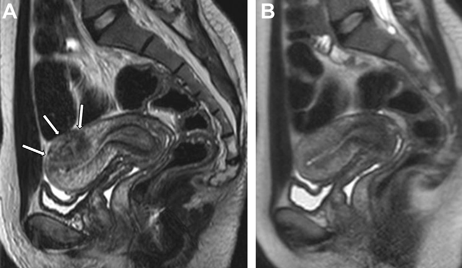 Figure 2. Physiologic transient myometrial contractions simulating adenomyosis in a 26-year-old woman.
- Sagittal T2-weighted MR images acquired a few minutes apart show a focal area of low signal intensity perpendicular to the JZ on the posterior uterine wall (arrows in A) that vanishes after a few minutes (B).