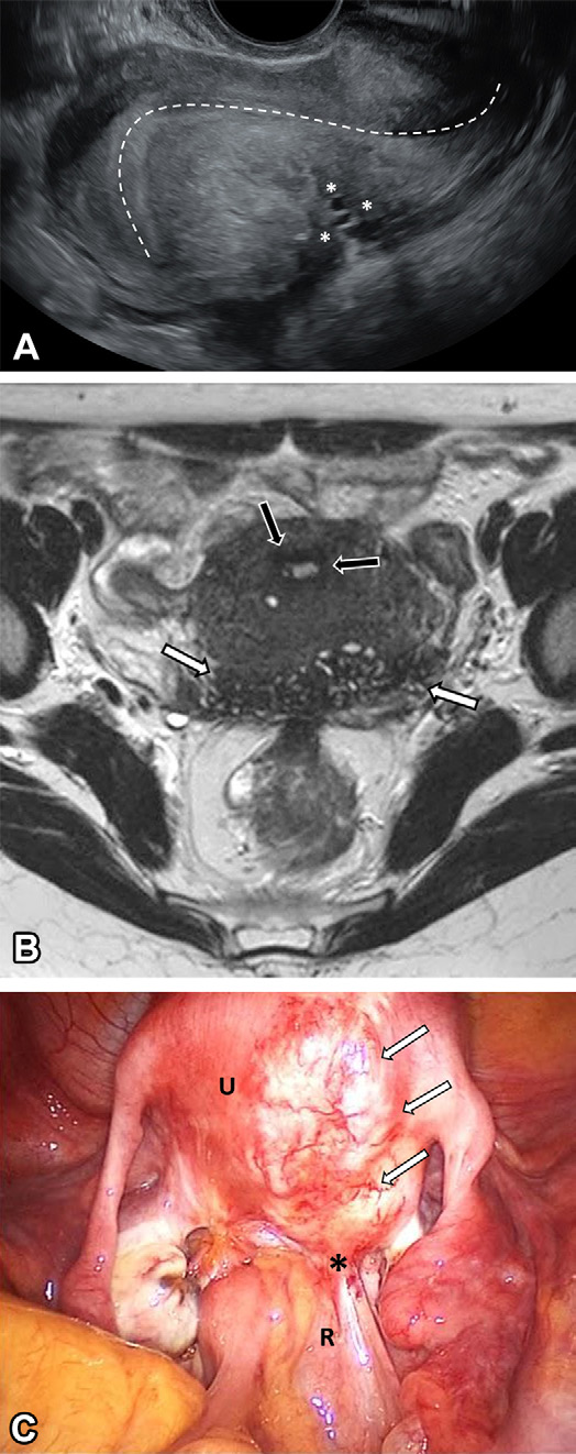 Figure 3. Deeply infiltrative endometriosis in two different women of reproductive age, both with severe dysmenorrhea.
- (A) Longitudinal US image shows a hypoechoic plaque lesion in the posterior uterine serosa, with small cystic areas infiltrating the myometrium (*) and causing uterine retractile retroflexion (dashed line).
- (B) Axial T2-weighted MR image shows a hypointense lesion in the posterior surface of the uterus, with multiple small hyperintense foci corresponding to endometrial glands (white arrows). The JZ appears normal (black arrows).
- (C) Laparoscopic view shows obliteration of the pouch of Douglas (*) with the rectum
- (R) tethered to the lesion (arrows) in the posterior aspect of the uterus (U). (Courtesy of Ricardo M. A. Pereira, MD.)