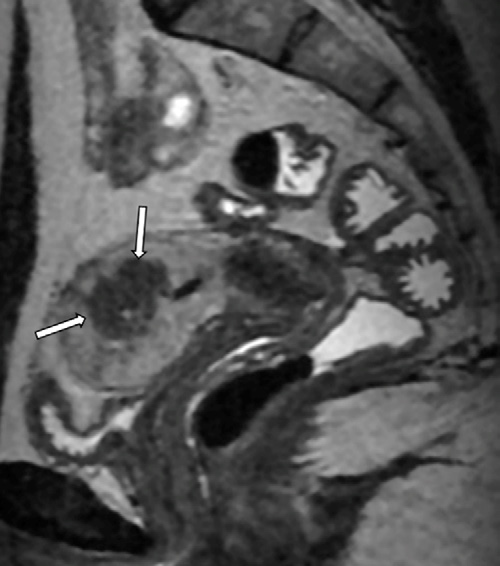 Figure 4. Adenomyoma in a 34-yearold woman with menorrhagia.
- Sagittal T2-weighted MR image shows a hypointense intramyometrial nodule in the posterior uterine wall, with partially defined margins, minimal mass effect, and small internal hyperintense foci (arrows).