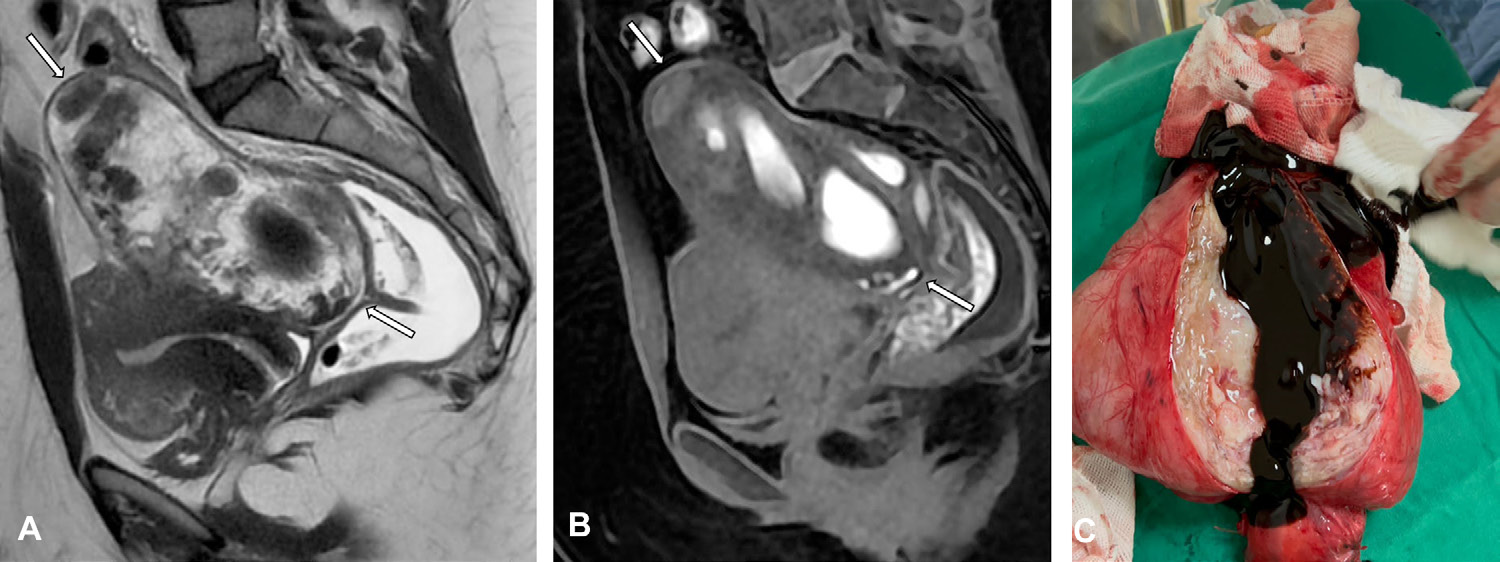 Figure 5. Subserosal adenomyoma in a 36-year-old woman with heavy menstrual cramps since adolescence that worsened in the last year.
- (A) Sagittal T2-weighted MR image shows a subserosal mass (arrows) in the posterior uterine wall, with heterogeneous signal intensity.
- (B) Sagittal T1-weighted MR image with fat saturation shows the mass (arrows) with areas of high signal intensity, indicating hemorrhagic content.
- (C) Photograph of gross specimen shows that it contains a large amount of chocolate-colored fluid.