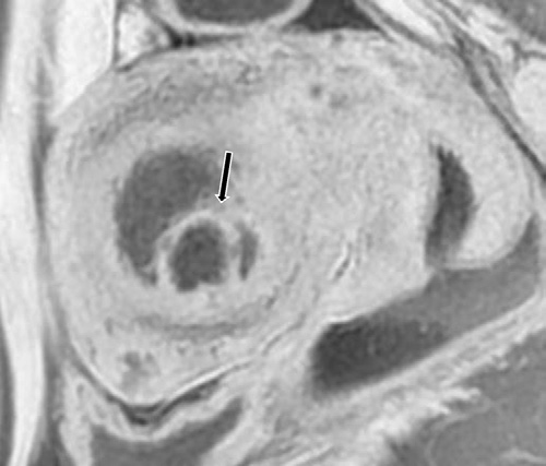 Figure 6. Submucosal cystic adenomyoma in a 45-year-old woman with infertility.
- Sagittal T2-weighted MR image show a round heterogeneous cystic lesion (arrow) distorting the uterine cavity.