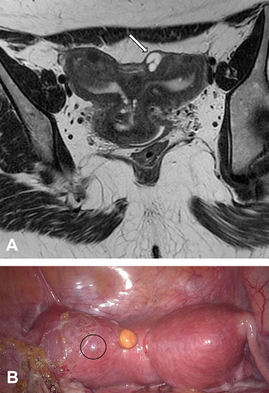 Figure 7. Cystic adenomyoma in a 42-year-old woman with Herlyn-Werner-Wunderlich syndrome.
- (A) Coronal T2-weighted MR image of the uterus shows a subserosal cystic lesion in the left hemiuterus (arrow).
- (B) Laparoscopic view shows the lesion (circle). (Courtesy of Ricardo M. A. Pereira, MD.)