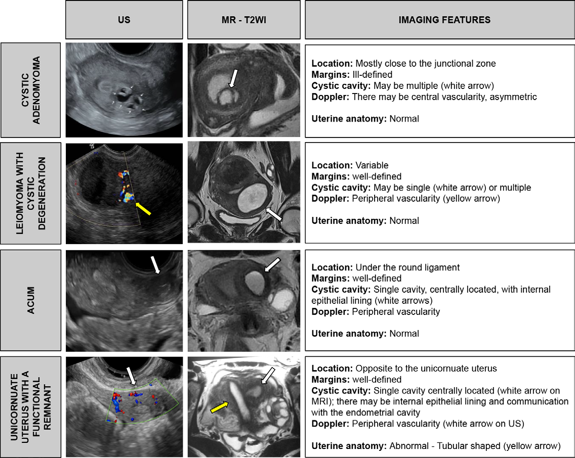 Figure 8. Tips for the differential diagnosis of cystic adenomyoma, leiomyoma with cystic degeneration, ACUM, and unicornuate uterus with a functional uterine remnant.
- T2WI = T2-weighted MRI.