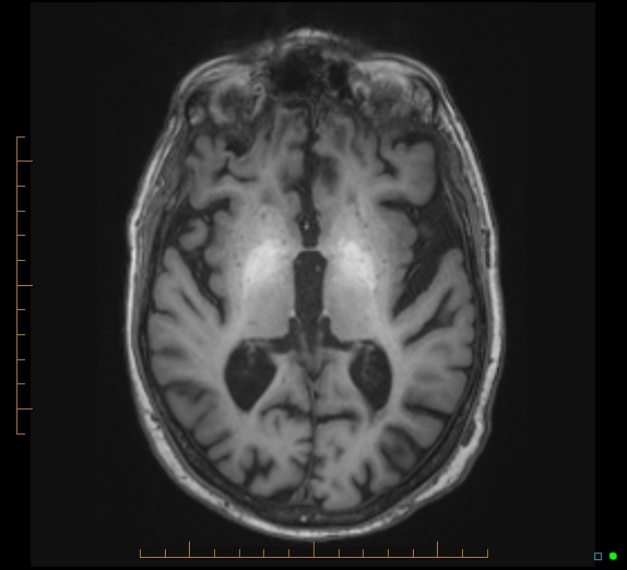 Acquired hepatocerebral degeneration