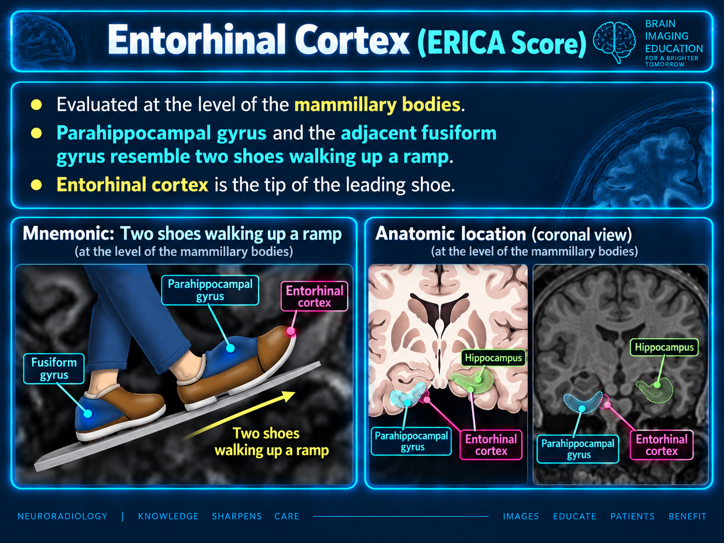Shoe mnemonic and coronal diagram and MRI localizing entorhinal cortex at mammillary body level