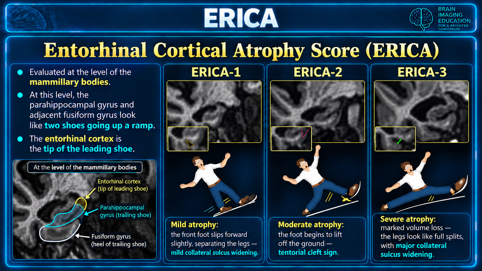 Coronal MRI examples of ERICA 1 to 3 with shoe-on-ramp teaching mnemonic