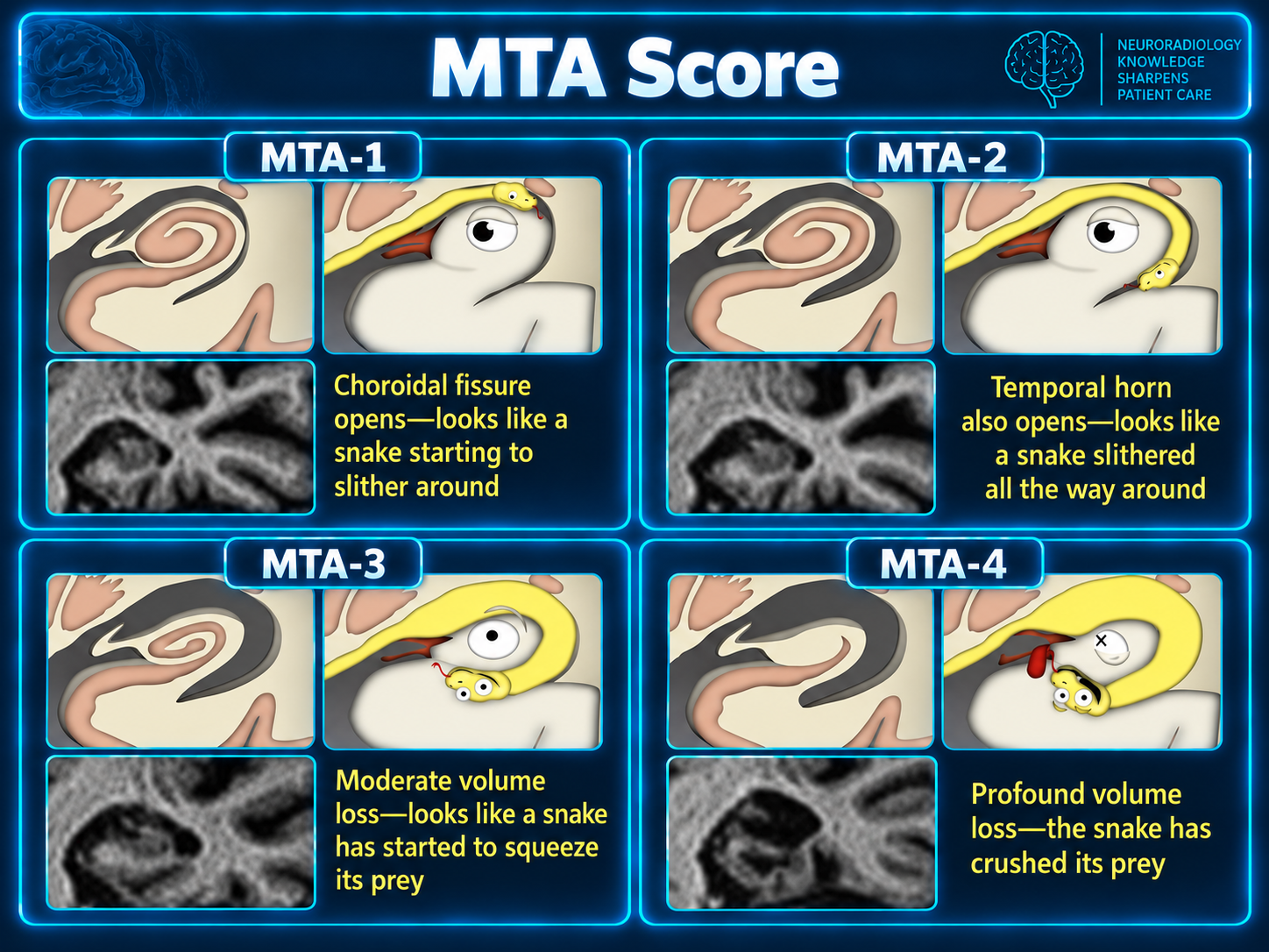 Coronal MRI and schematic mnemonic illustrating MTA grades 1 to 4