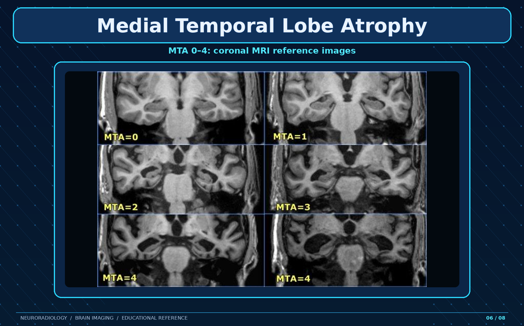 MTA coronal reference