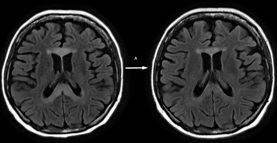 Marchiafava-Bignami disease



Diminished FLAIR hyperintensity (right) compared to the initial MRI scan at day 2 (left).



Treatment with thiamine administration is advised. [11] Our patient received parenteral thiamine and had a favourable course with complete clinical recovery