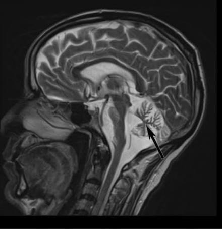 Cerebellar Atrophy