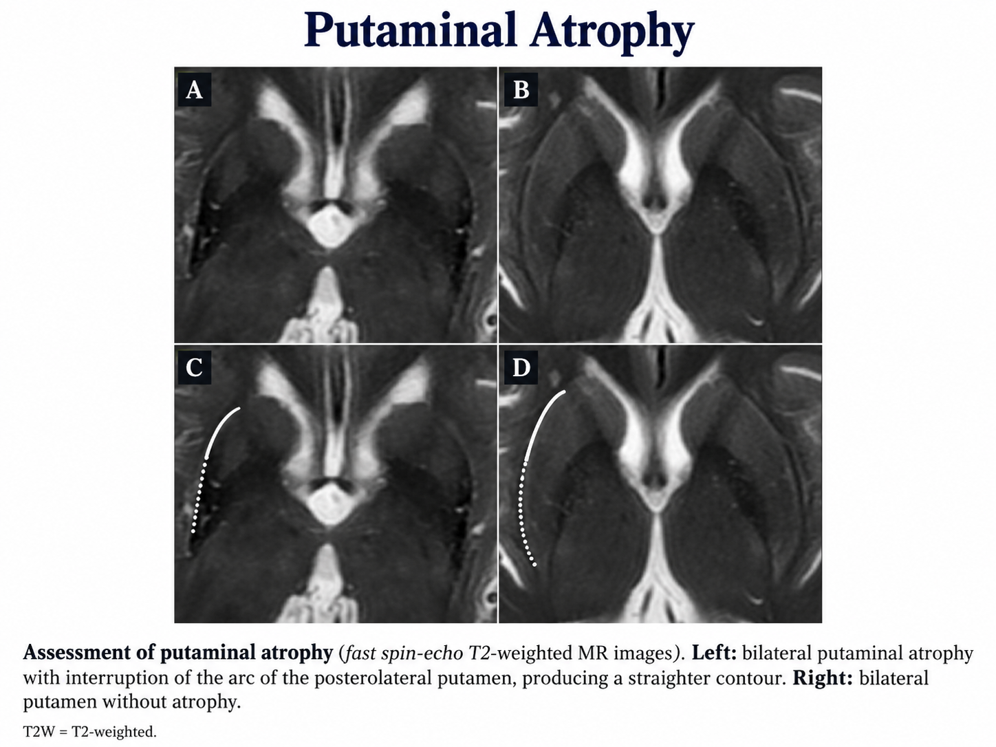Putamen Atrophy