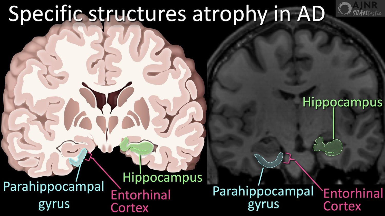 Coronal diagram and MRI labeling hippocampus, parahippocampal gyrus, and entorhinal cortex