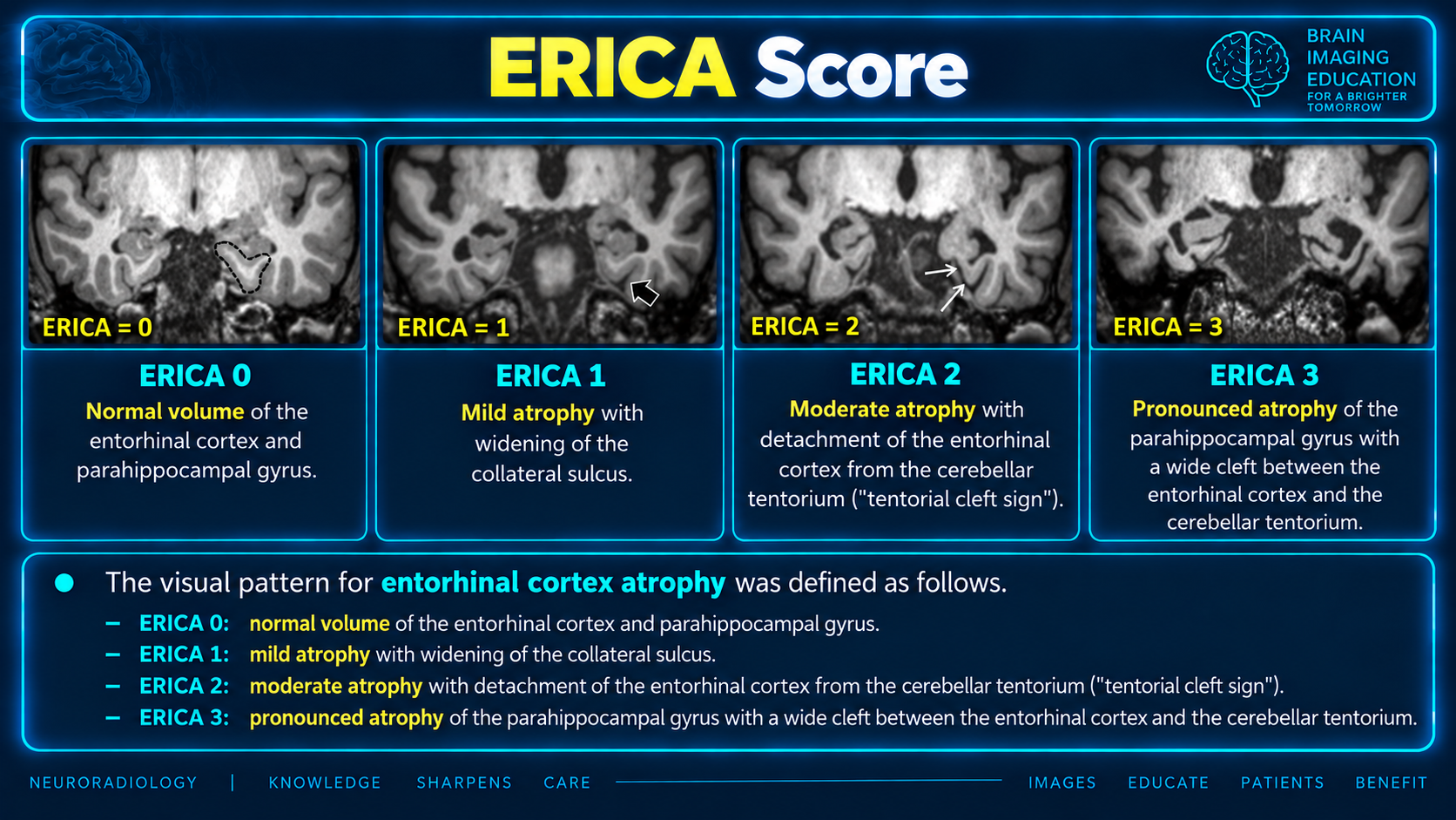 Coronal MRI examples illustrating ERICA scores 0 to 3