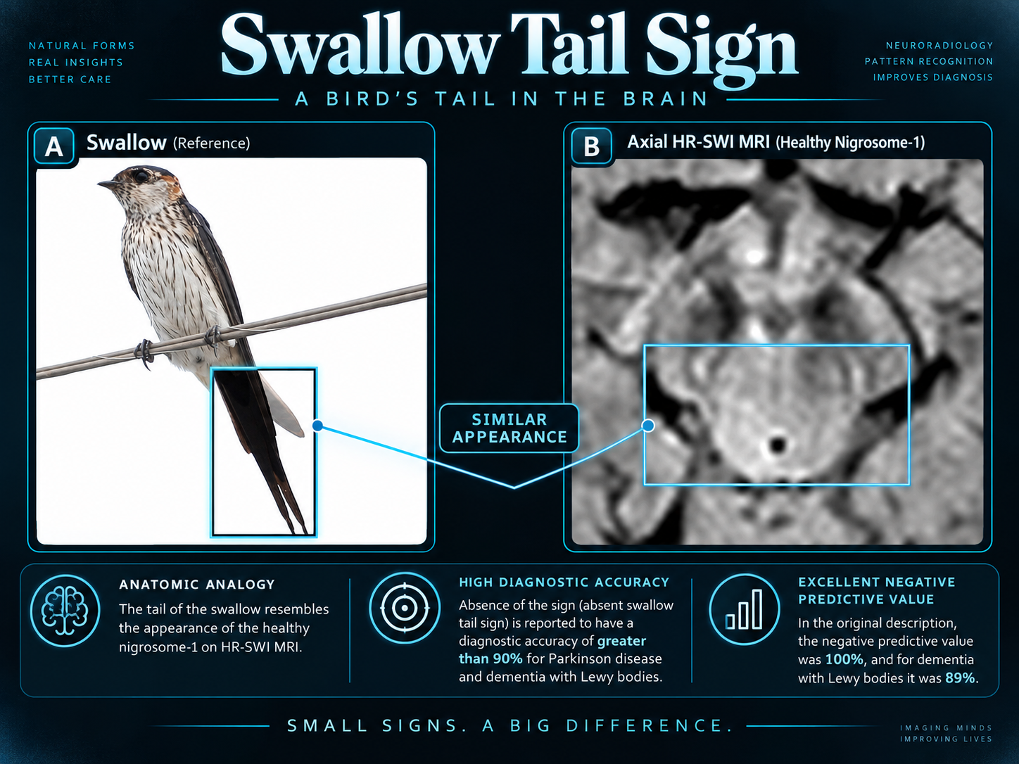 Swallow comparison with healthy nigrosome-1 on axial high-resolution SWI MRI