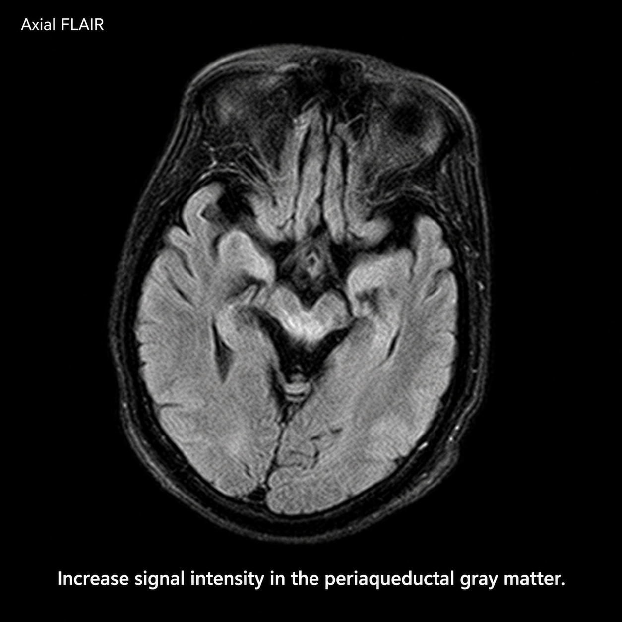 Axial FLAIR MRI labeled increased periaqueductal gray matter signal