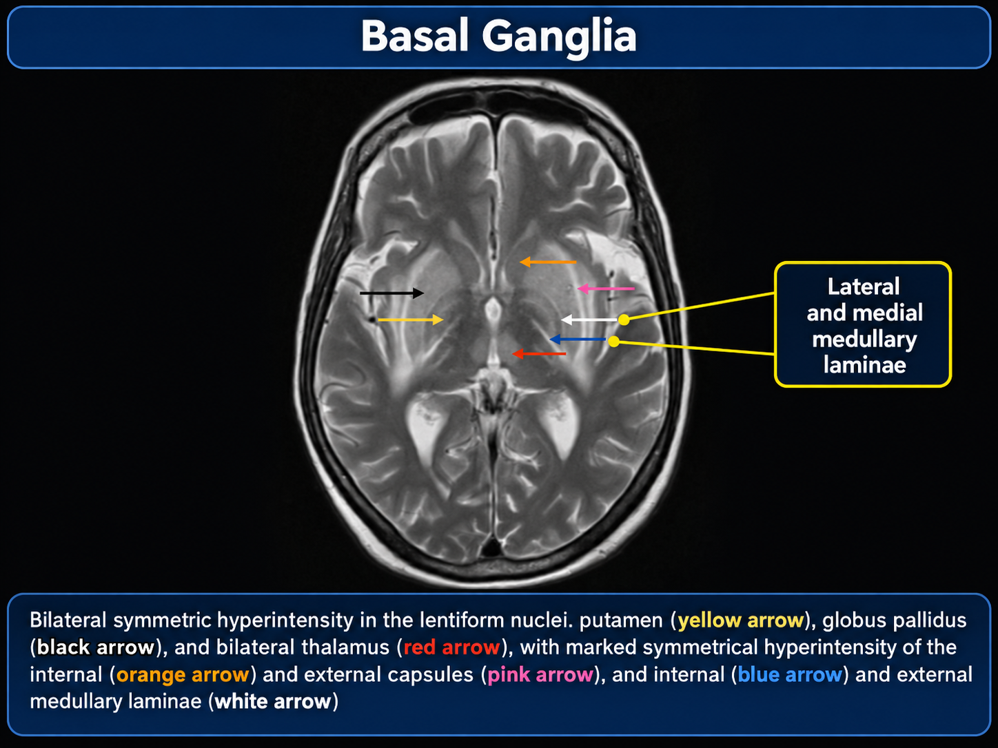 Basal ganglia anatomy on MRI