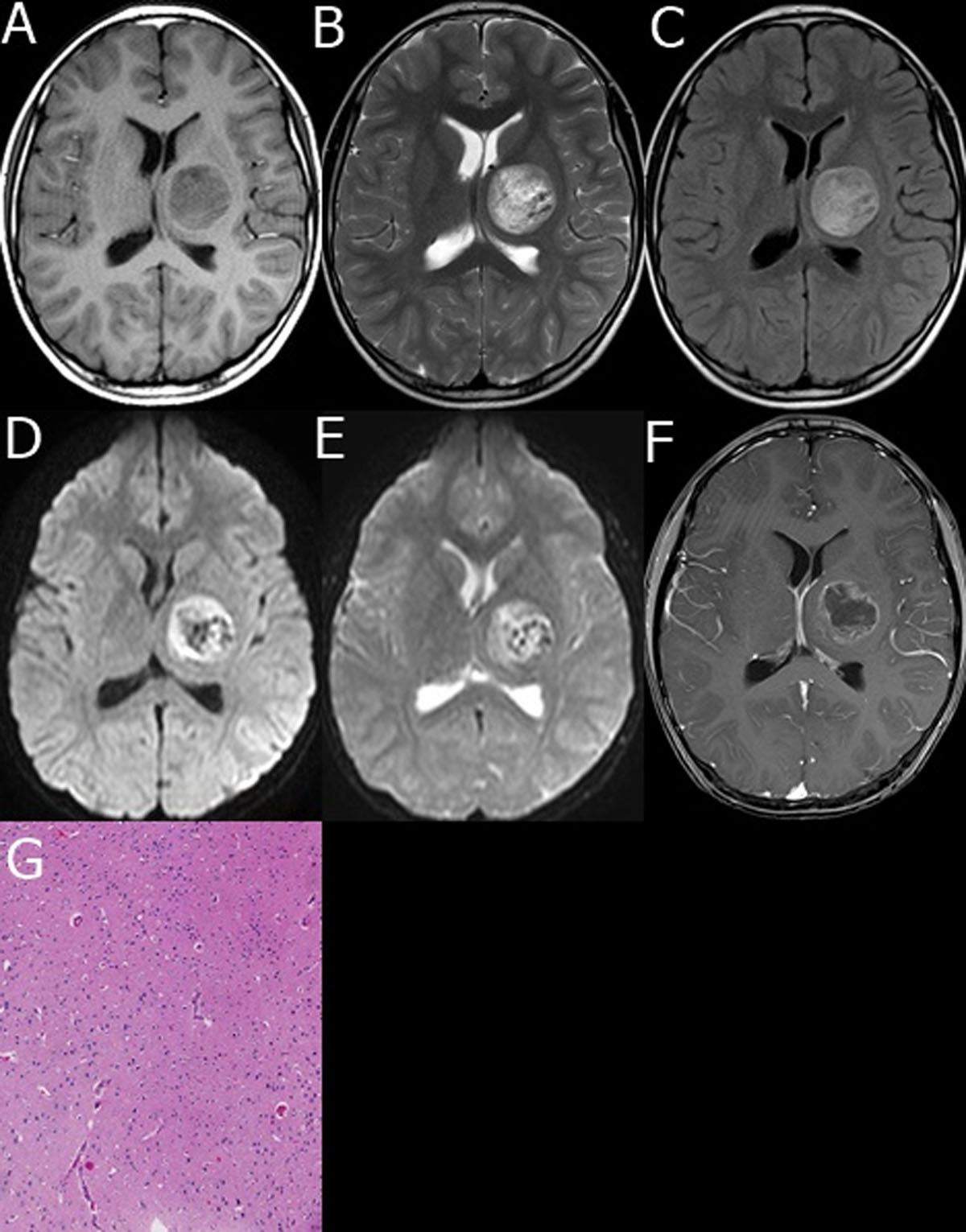 A–G male, 8 years old, with DNET in the left basal ganglia. A. T1WI left basal ganglia tumor showed iso- and low mixed signal; B. T2WI tumor showed iso- and slightly high and low mixed signal; C. FLAIR tumor showed iso- and slightly high mixed signal; D. DWI tumor showed iso- and low mixed signal; E. ADC diagram tumor showed high signal intensity; F. enhanced MRI of tumor showed annular enhancement; G. pathological images showed that the tumor tissue was formed by abundant mucous matrix and microcapsules. The morphology was similar to astrocytes and oligodendrocytes, and a few neurons were seen with slightly increased number of glial cells (