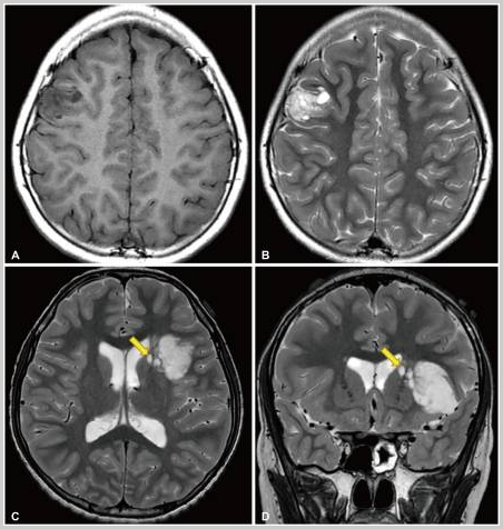 A and B: T1-weighted and T2-weighted magnetic resonance images of a 10-year-old girl who presented with recurrent focal seizures. A multinodular mass is located in the right middle frontal gyrus. C and D: T2-weighted axial and coronal images of a 12-year-old boy who came to the clinic for chronic epilepsy. A large tumor is situated in the insular and left inferior frontal lobes. There are several satellite lesions (yellow arrows) on the medial side of the mass, in the caudate nucleus and internal capsule.