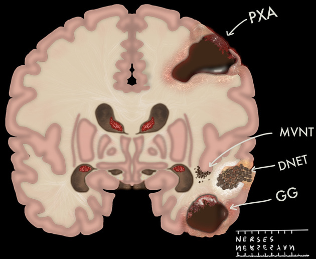 Long-term epilepsy-associated tumors (LEAT)