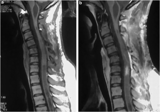 Spinal cord Ganglioglioma