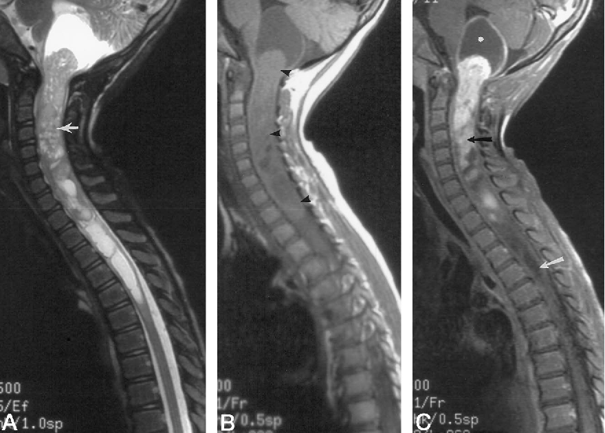 Ganglioglioma