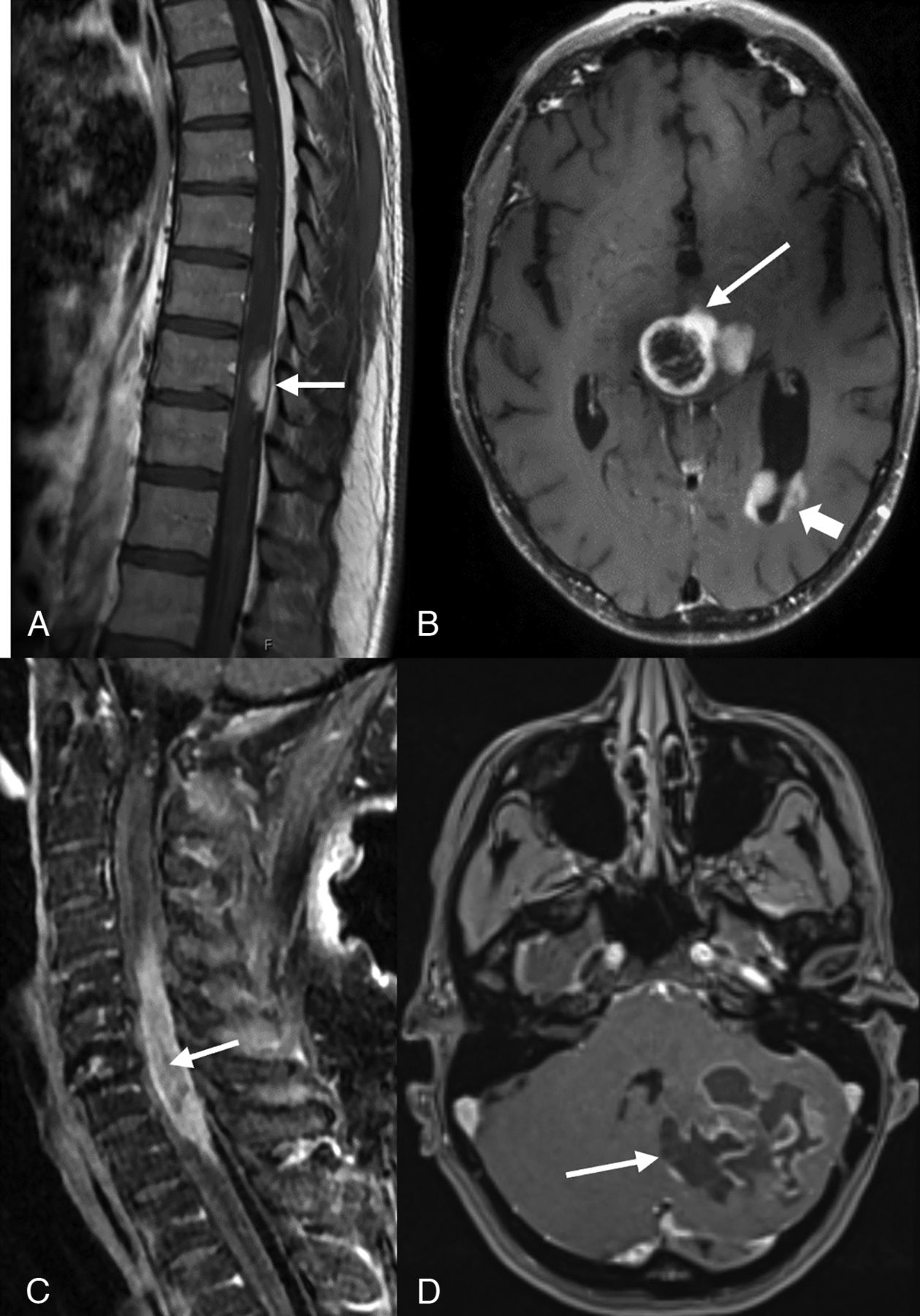 (A) image of a 44-year-old man with midback pain shows a well-defined enhancing lesion involving the dorsal aspect of thoracic cord at the T9–T10 level (arrow). Postcontrast T1-weighted axial image in a 42-year-old man (B) shows tumor with peripheral irregular enhancement at the level of thalamus (arrow) with infratentorial pontomesencephalic and cerebellar involvement (not shown) along with diffuse intraventricular tumor seeding (arrowhead). Postcontrast T1-weighted sagittal (C) image of a 74-year-old-man with weakness and difficulty walking shows an intramedullary heterogeneously enhancing tumor involving nearly the entire cord C5–T1 (arrow) along with cord expansion. Postcontrast T1-weighted-axial (D) image in a 38-year-old man demonstrates a large multicystic lesion with peripheral enhancement in the left cerebellum (arrow).