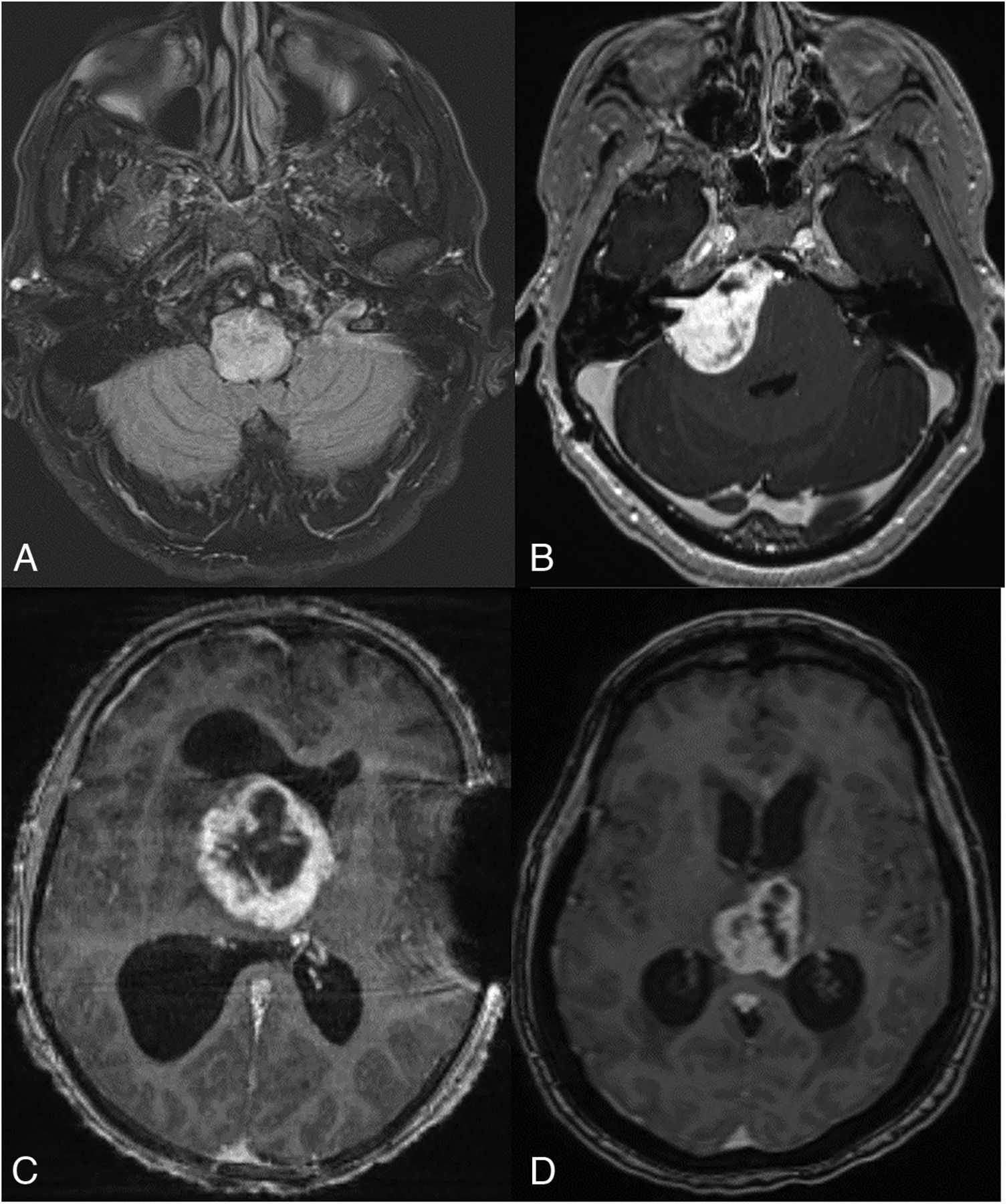 44-year-old man (A) with dyspnea and vocal cord paralysis shows an expansile hyperintense lesion in the pontomedullary region with patchy ill-defined enhancement (not shown). Postcontrast T1-weighted axial MR images (not images). B, A 32-year-old woman presenting with hearing loss demonstrates a large, right pontine tumor extending into the right cerebellopontine angle, internal auditory canal, and prepontine cistern. Postcontrast T1-weighted axial MR images (C and D) demonstrate a midline, diencephalic/thalamic region tumor with rim enhancement in a 19-year-old man (C) and a 71-year-old woman (D).