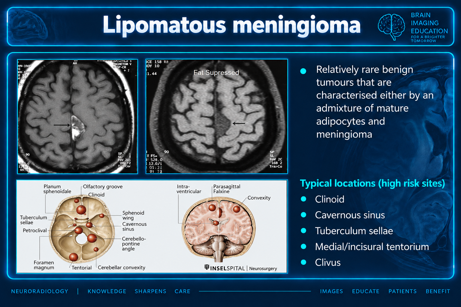 Axial MRI images of a labeled lipomatous meningioma before and with fat suppression, with location diagrams.