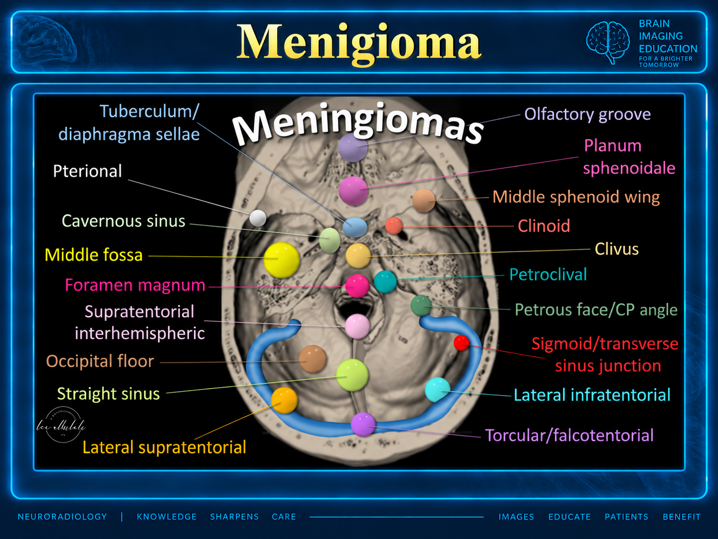 Annotated skull-base diagram showing meningioma locations and dural venous sinus relationships.