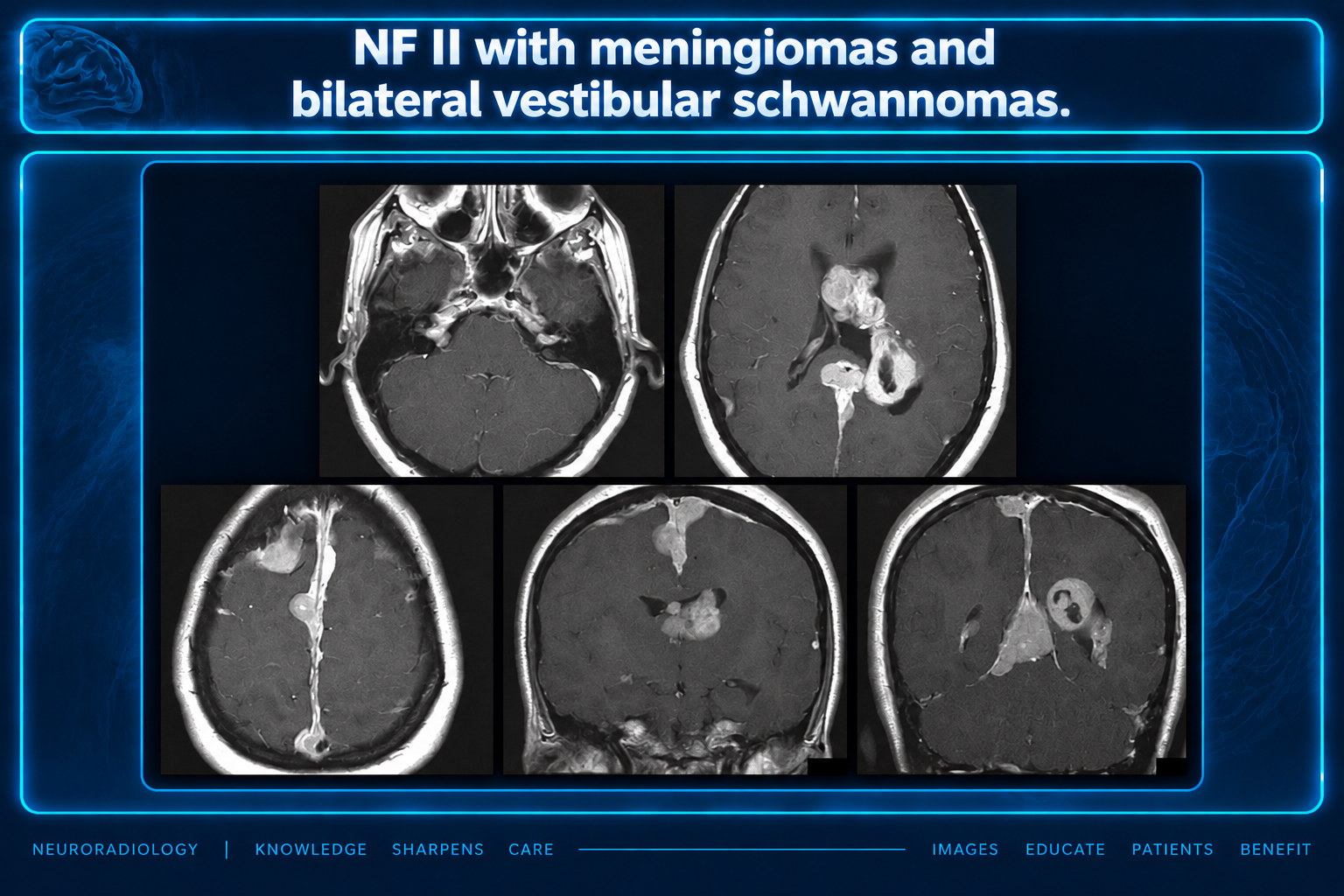 Axial and coronal contrast-enhanced MRI montage labeled NF II with meningiomas and bilateral vestibular schwannomas.
