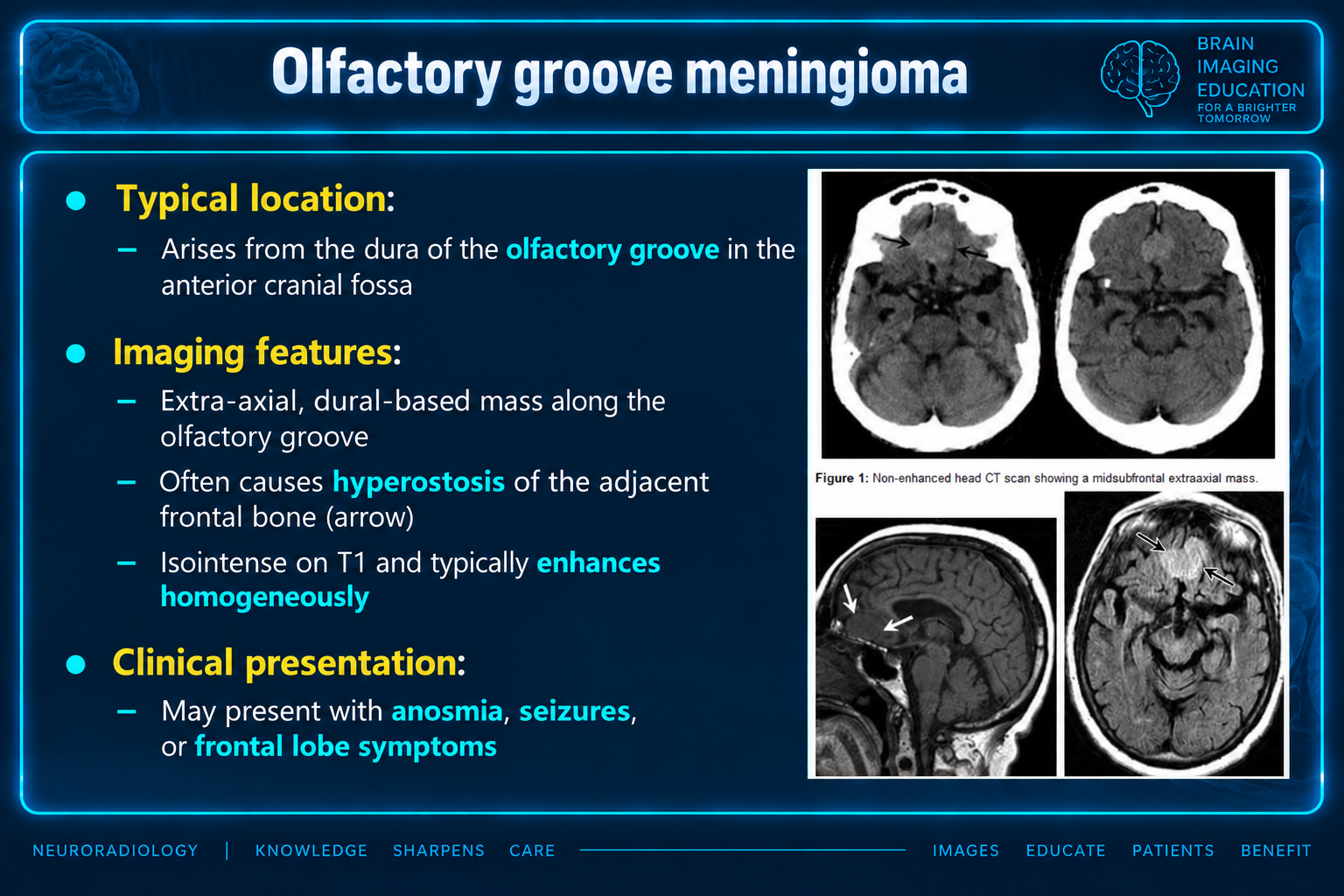 Axial CT and sagittal and axial MRI teaching montage with arrows at an olfactory groove extra-axial mass.