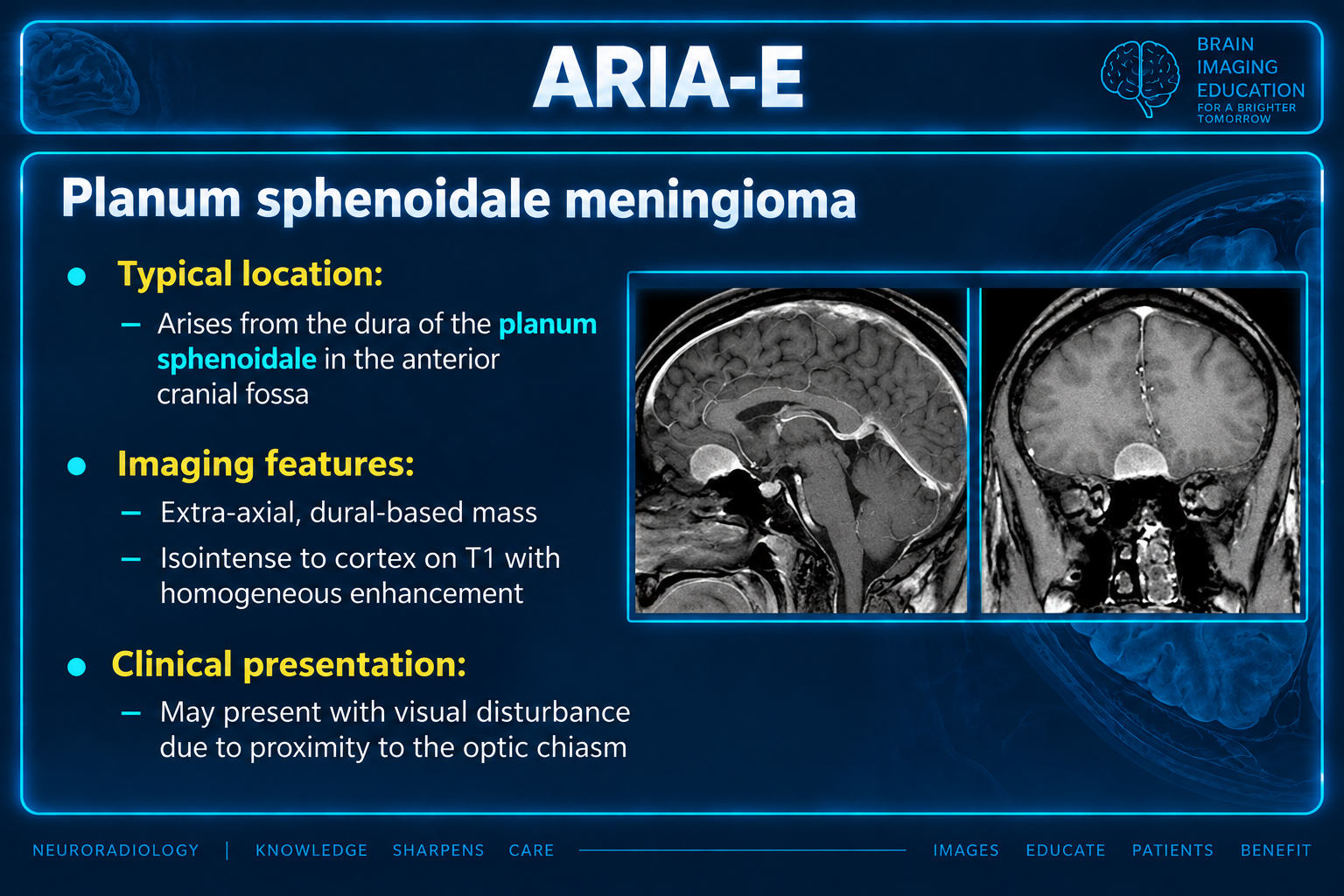Sagittal and coronal contrast-enhanced MRI showing the labeled planum sphenoidale dural-based mass.