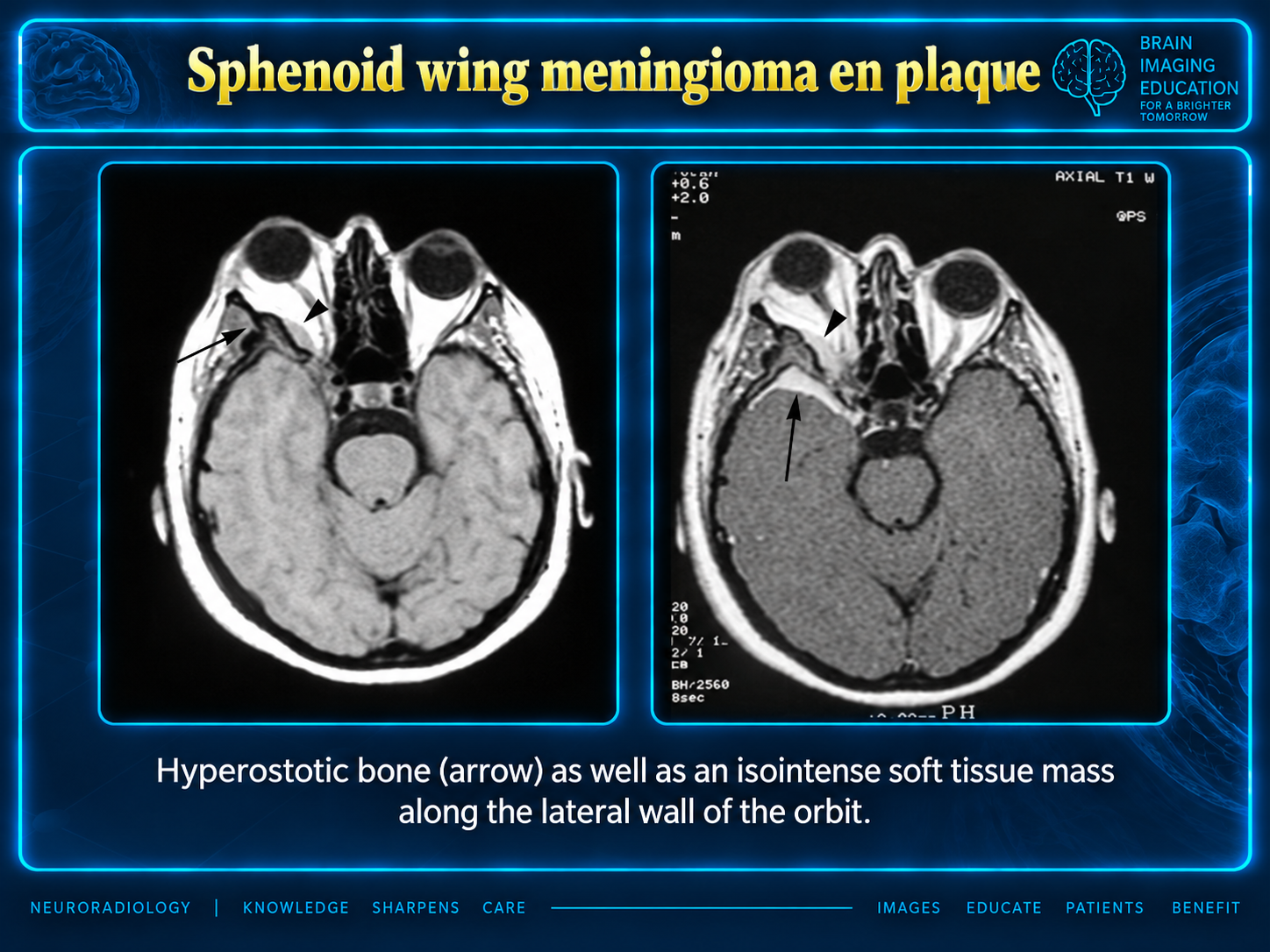 Paired axial T1-weighted MRI images with arrows indicating sphenoid-wing hyperostotic bone and soft tissue along the lateral orbital wall.